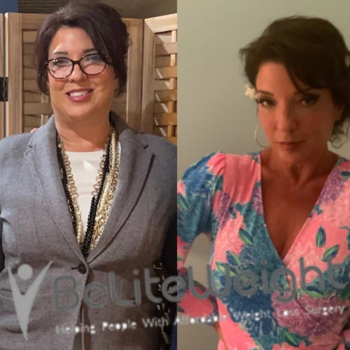 Weight Loss Surgery Before And After